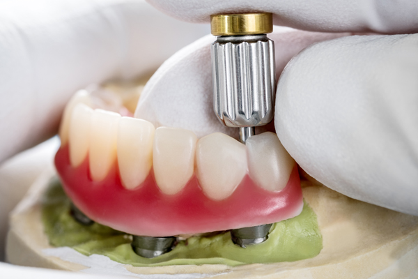 The Longevity Of Implant Supported Dentures