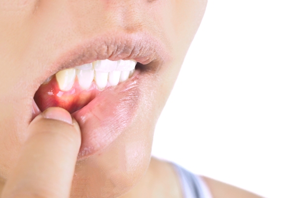 Understanding Common Gum Disease Treatments By General Dentists